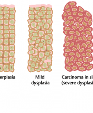 Cancer progression from NIH